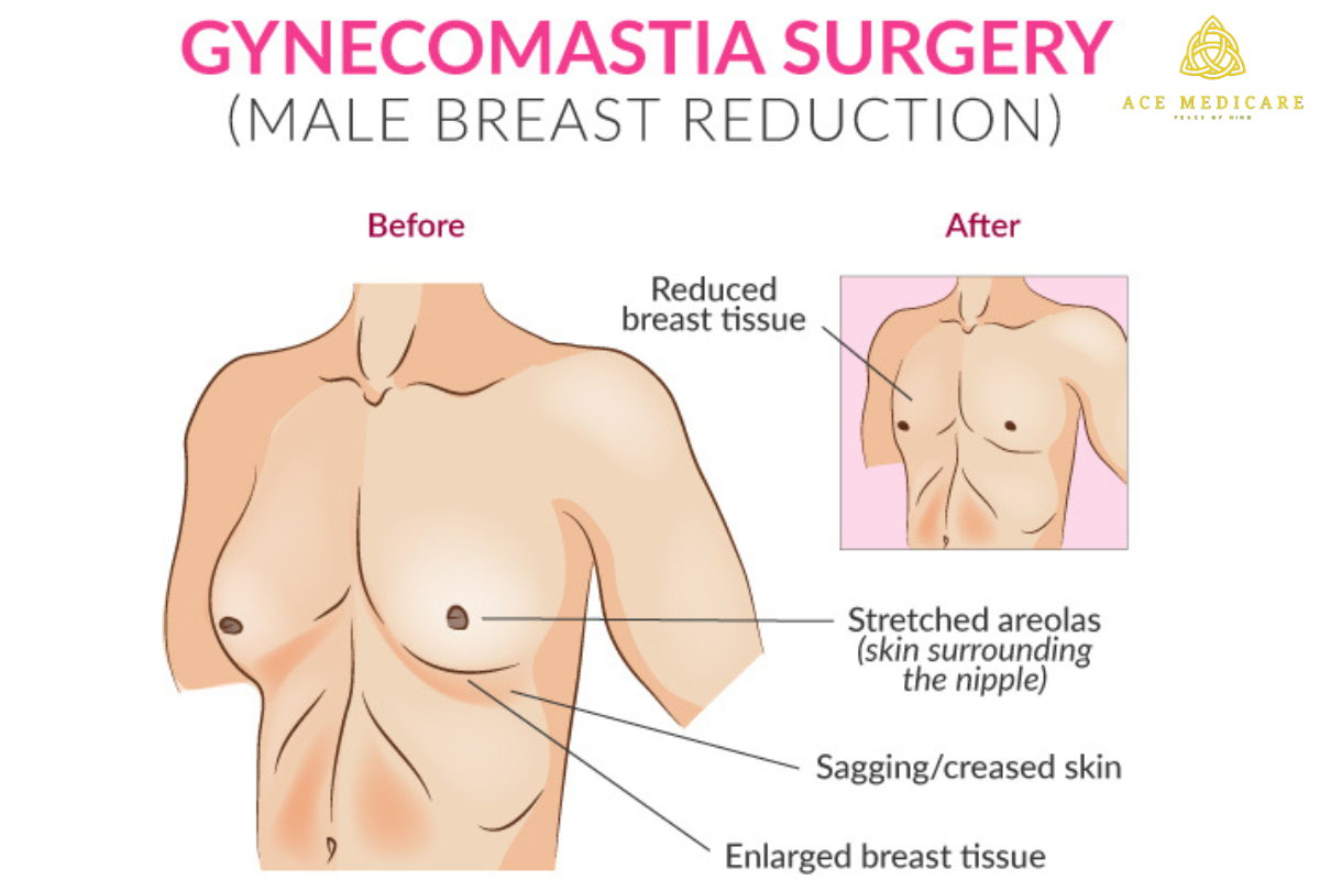 Understanding Gynecomastia: Causes and Symptoms